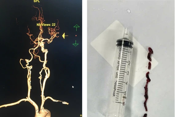 Đi viện điều trị đau bụng, cụ bà 75 tuổi đột quỵ