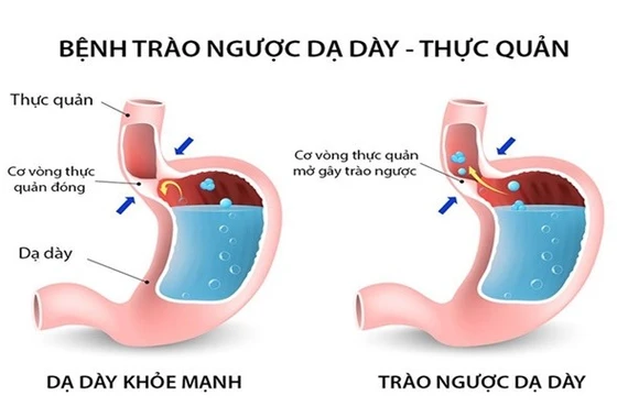Bác sĩ mách cách chữa bệnh trào ngược dạ dày - thực quản hiệu quả