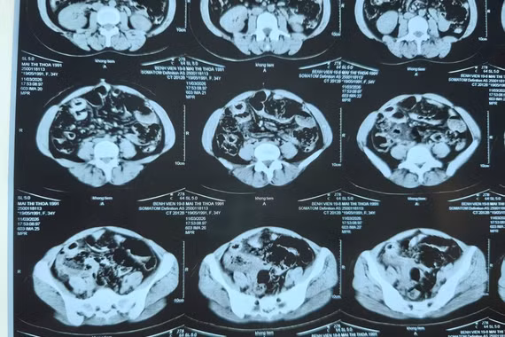 Cảnh giác tắc ruột do biến chứng đa túi thừa ruột non ở người trẻ