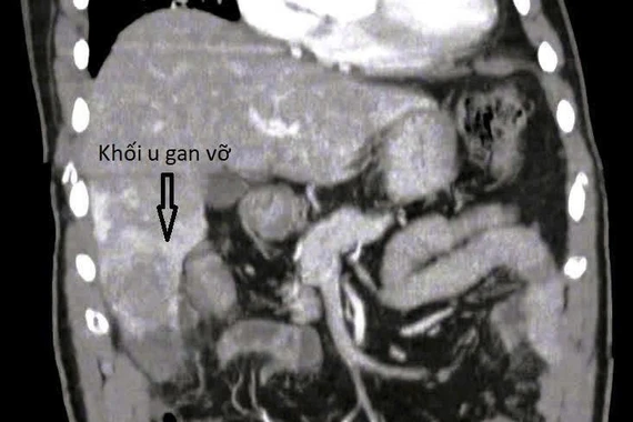 Đau hạ sườn 1 ngày, người đàn ông vỡ u gan nguy kịch