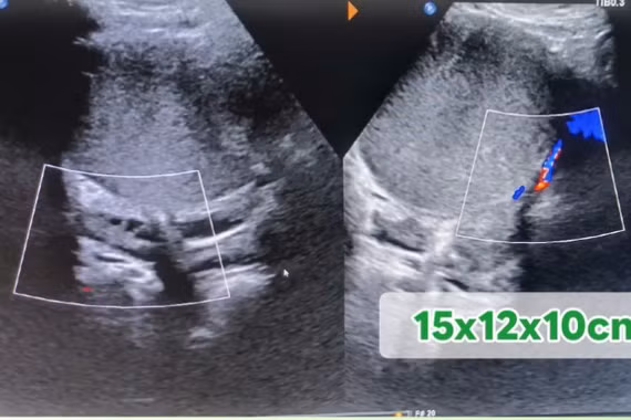 Gái trẻ chưa chồng bụng dưới to, căng do u khủng