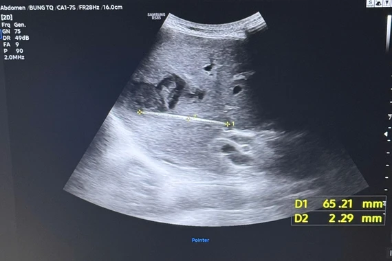 Lấy tăm ngậm xuyên vào gan cho người bệnh 65 tuổi