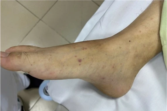 Sốt cao tự truyền dịch, người bệnh nguy kịch vì viêm màng não mô cầu