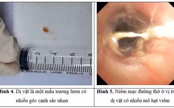 Dị vật 'bị bỏ quên' hơn 1 tháng trong phế quản bé trai 3 tuổi 