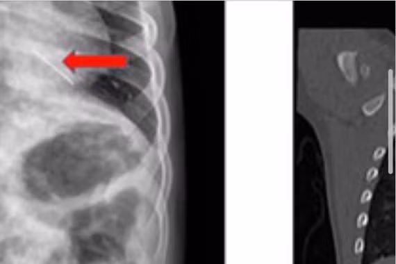 Ho ra máu đỏ tươi, không ngờ trẻ 3 tuổi nuốt đoạn kẽm nhung dài 2cm