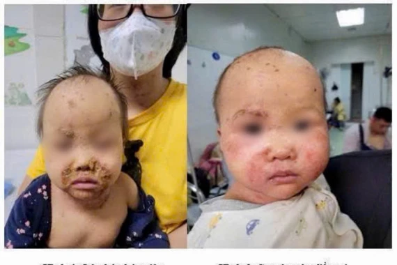 Bé 10 tháng viêm kết mạc nặng sau 1 ngày gia đình tự nhỏ thuốc