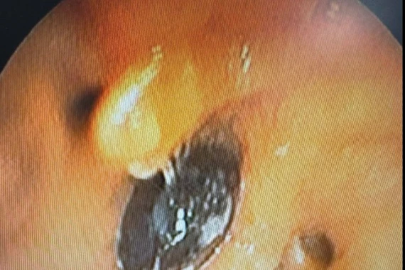 Ho, khó thở kéo dài do hạt hồng xiêm trú ngụ 4 tháng trong phế quản