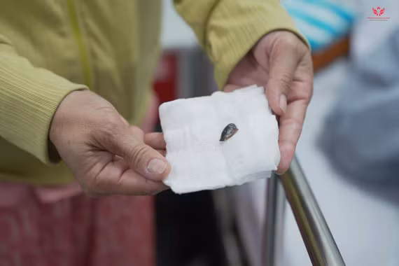 Ho kéo dài điều trị không khỏi do hạt hồng xiêm trong phế quản