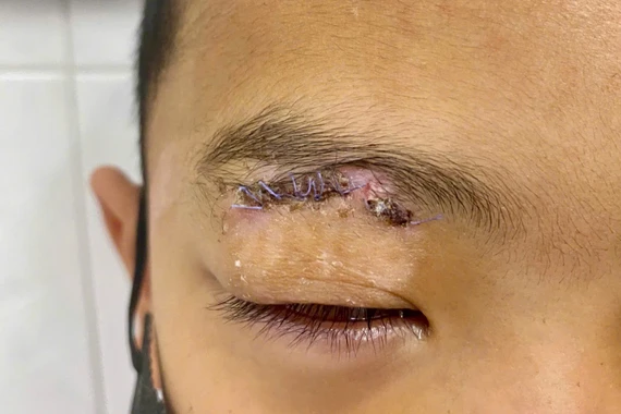 Hàng loạt ca chấn thương mắt trẻ em do pháo trong dịp Tết Bính Ngọ