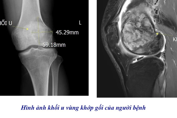 Chủ quan đau âm ỉ khớp gối, người đàn ông phát hiện u tế bào khổng lồ