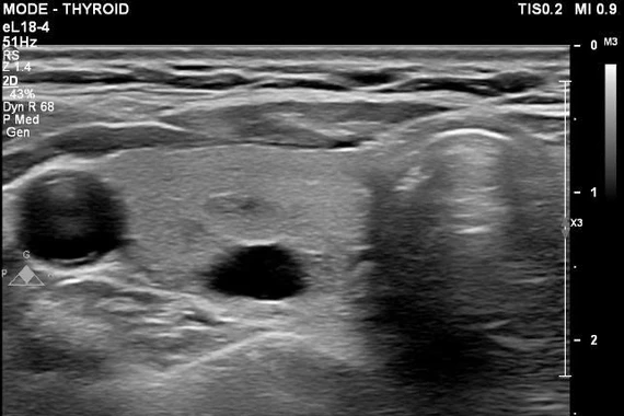 Bác sĩ chỉ rõ dấu hiệu, cách theo dõi nang tuyến giáp an toàn