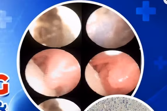 Ca bệnh cực hiếm: Bé sơ sinh mang mô thần kinh 'đi lạc; trong mũi họng 