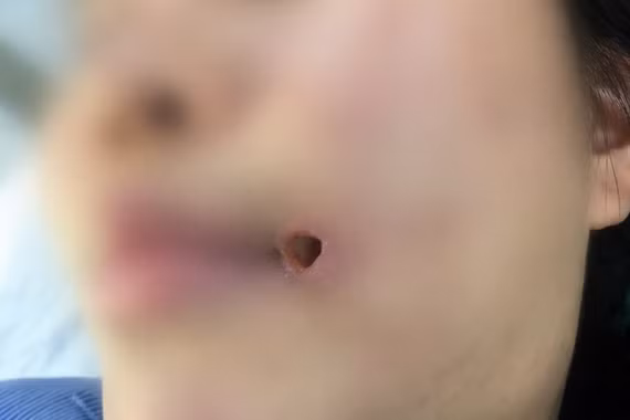 1 năm sau tiêm filler, cô gái 21 tuổi viêm tấy mặt do tụ cầu vàng