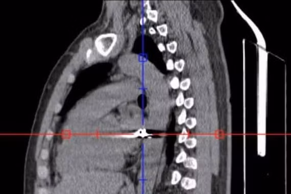 Cứu sống bệnh nhân bị đạn bắn xuyên ngực