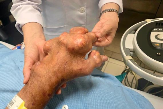 Điều trị gút có phải chỉ cần giảm đau khi có cơn cấp?