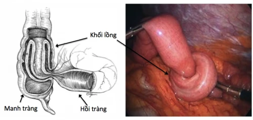 Cảnh báo lồng ruột ở trẻ nhỏ, cách xử trí