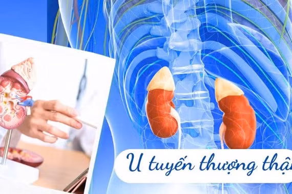 U tuyến thượng thận nhỏ nhưng gây nhiều rối loạn nguy hiểm