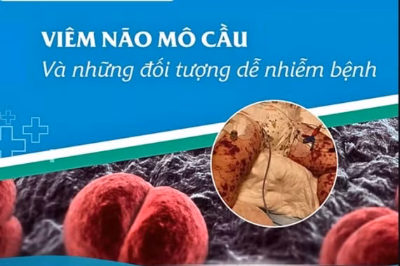 Nguy cơ bùng phát viêm não mô cầu trong cộng đồng, cách gì ngăn ngừa?