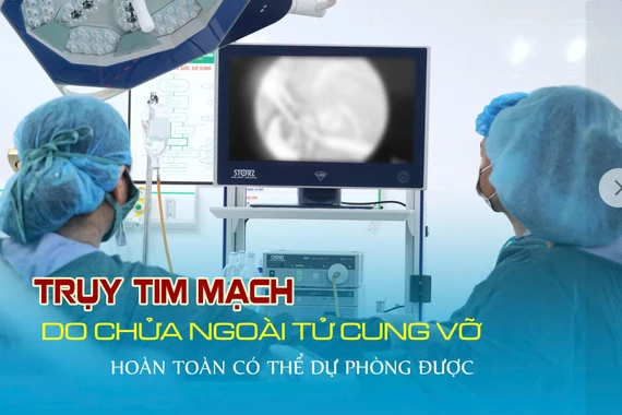 Cứu sản phụ chửa ngoài tử cung trụy mạch