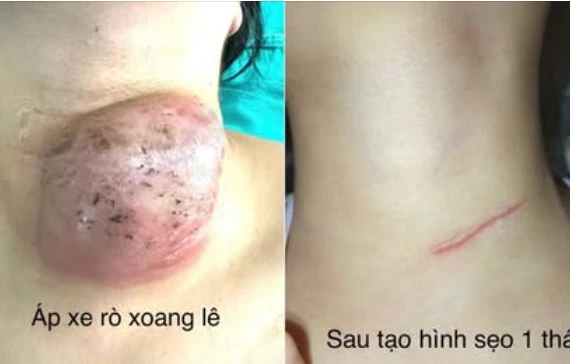 U nang vùng cổ rò xoang lê thường gặp ở trẻ, dễ tái phát