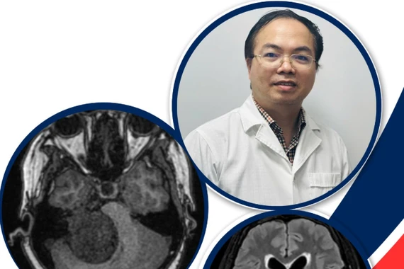 Nhìn mờ, méo miệng, thai phụ sinh con lần 5 phát hiện u não lớn