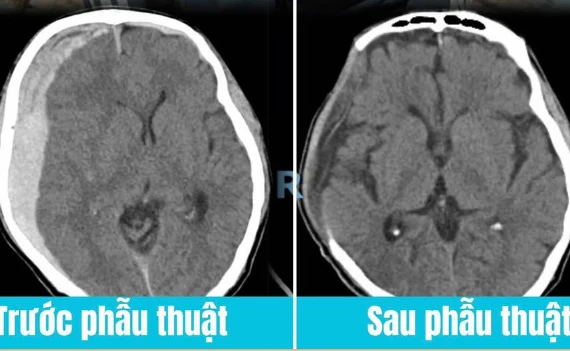 Cứu sống bệnh nhân tụ máu não sau cú ngã nhẹ chỉ đau đầu gối
