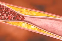 Cảnh báo 3 dấu hiệu mỡ máu cao hiện rõ trên khuôn mặt