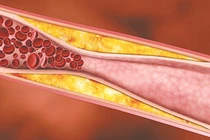 Cảnh báo 3 dấu hiệu mỡ máu cao hiện rõ trên khuôn mặt