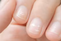 Cẩn trọng khi móng tay xuất hiện vệt trắng bất thường