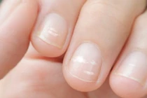 Cẩn trọng khi móng tay xuất hiện vệt trắng bất thường