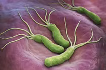 Viêm teo dạ dày giai đoạn sớm của ung thư, chớ nên chủ quan 