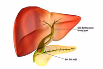 Cụ bà 76 tuổi suýt cắt gan vì... sỏi mật lớn bất thường 