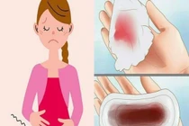 Ra máu kinh bất thường, phát hiện u xơ dễ gây hiếm muộn