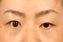 Bé gái sụp mi, phát hiện hội chứng Marcus Gunn hiếm gặp