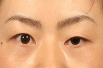 Bé gái sụp mi, phát hiện hội chứng Marcus Gunn hiếm gặp