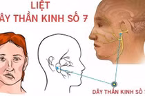 Trẻ bị liệt mặt do ngủ điều hòa, quạt sai cách mùa hè