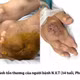 Tự chữa gout, người đàn ông 34 tuổi đối mặt án tử vì nhiễm khuẩn huyết