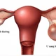 U nang buồng trứng khổng lồ chiếm toàn bộ ổ bụng người phụ nữ 43 tuổi
