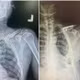 Ngã gãy nhiều xương sườn, xương đòn, người đàn ông được cứu bằng một thì mổ