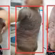 Bé trai mang khối u như mai rùa suốt 7 năm lần đầu đứng thẳng
