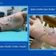 Bỏng ống xả xe máy phải phẫu thuật chuyển vạt che gót chân biến chứng