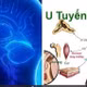 Tăng cân nhanh, béo bụng không ngờ u tuyến yên