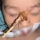 Que xiên thịt đâm từ mũi lên hốc mắt, bé gái 2,5 tuổi thoát nguy cơ xuyên sọ