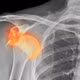 Tự nắn sau chấn thương, người đàn ông liên tục trật khớp vai