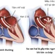 Không triệu chứng, người 40 năm khỏe mạnh phát hiện bệnh tim nguy hiểm