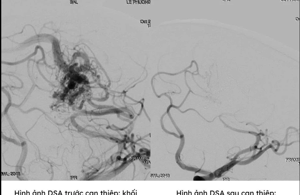 Tưởng đau đầu bình thường, cô gái 25 tuổi bị xuất huyết não