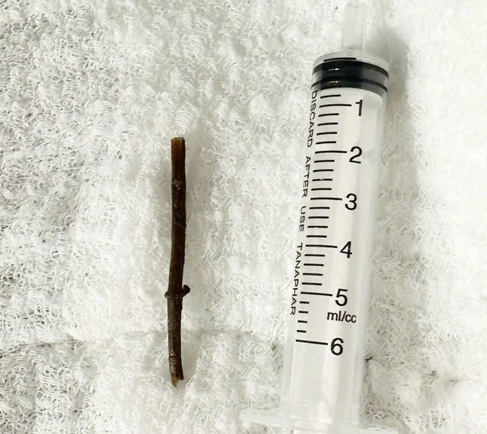 Uống thuốc lá tự sắc, người đàn ông bị thủng dạ dày do mảnh cây