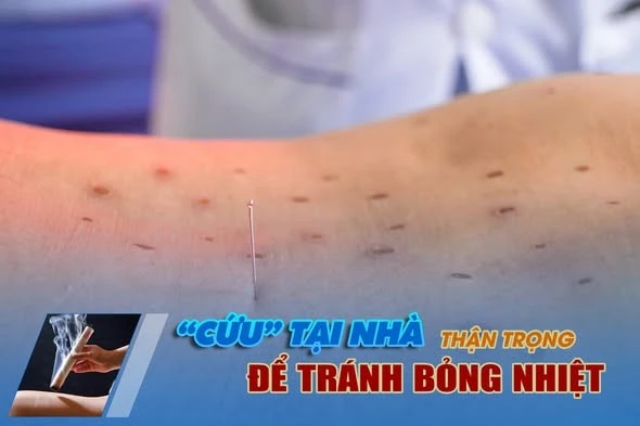 Bỏng khắp lưng vì cứu ngải không đúng kỹ thuật tại thầy lang