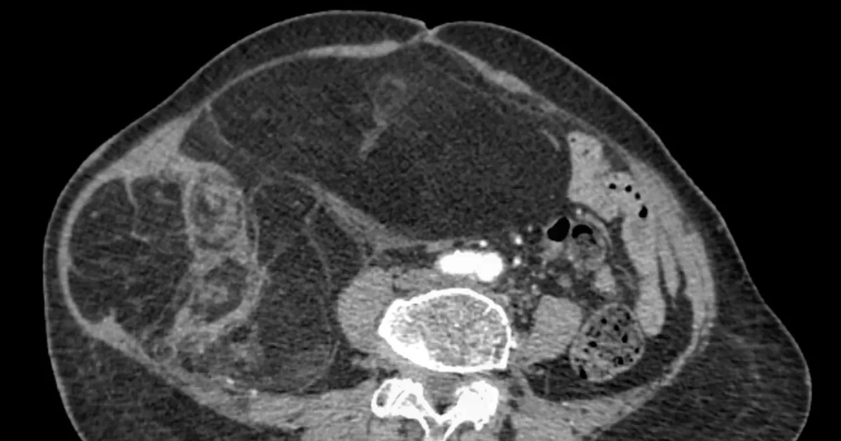 Bụng to nhanh, người phụ nữ 76 tuổi không ngờ mang u ác nặng 4 kg