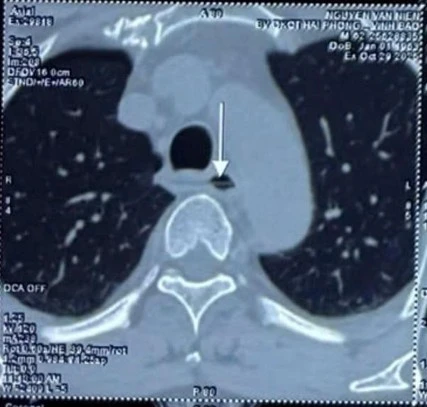 Ca cấp cứu nghẹt thở, dị vật sắc nhọn xuyên thực quản, sát động mạch chủ